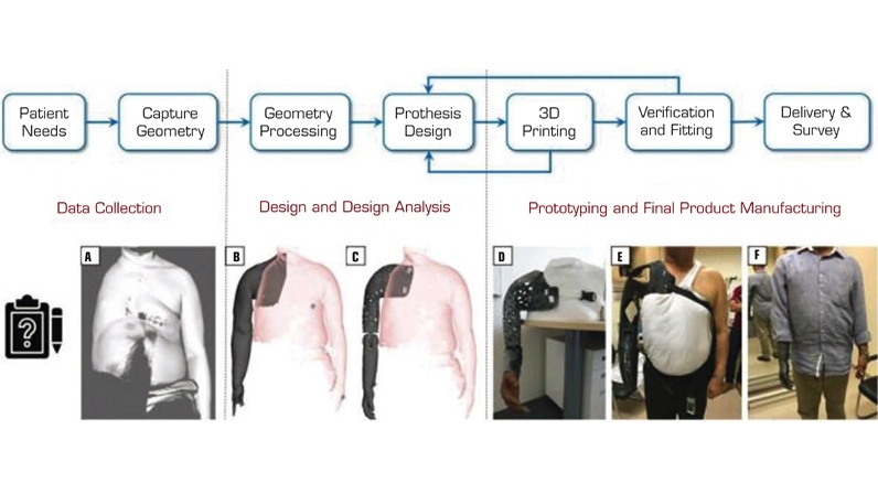 Low-Cost, Customized Prosthesis Using 3D Printing - Medical Design Briefs