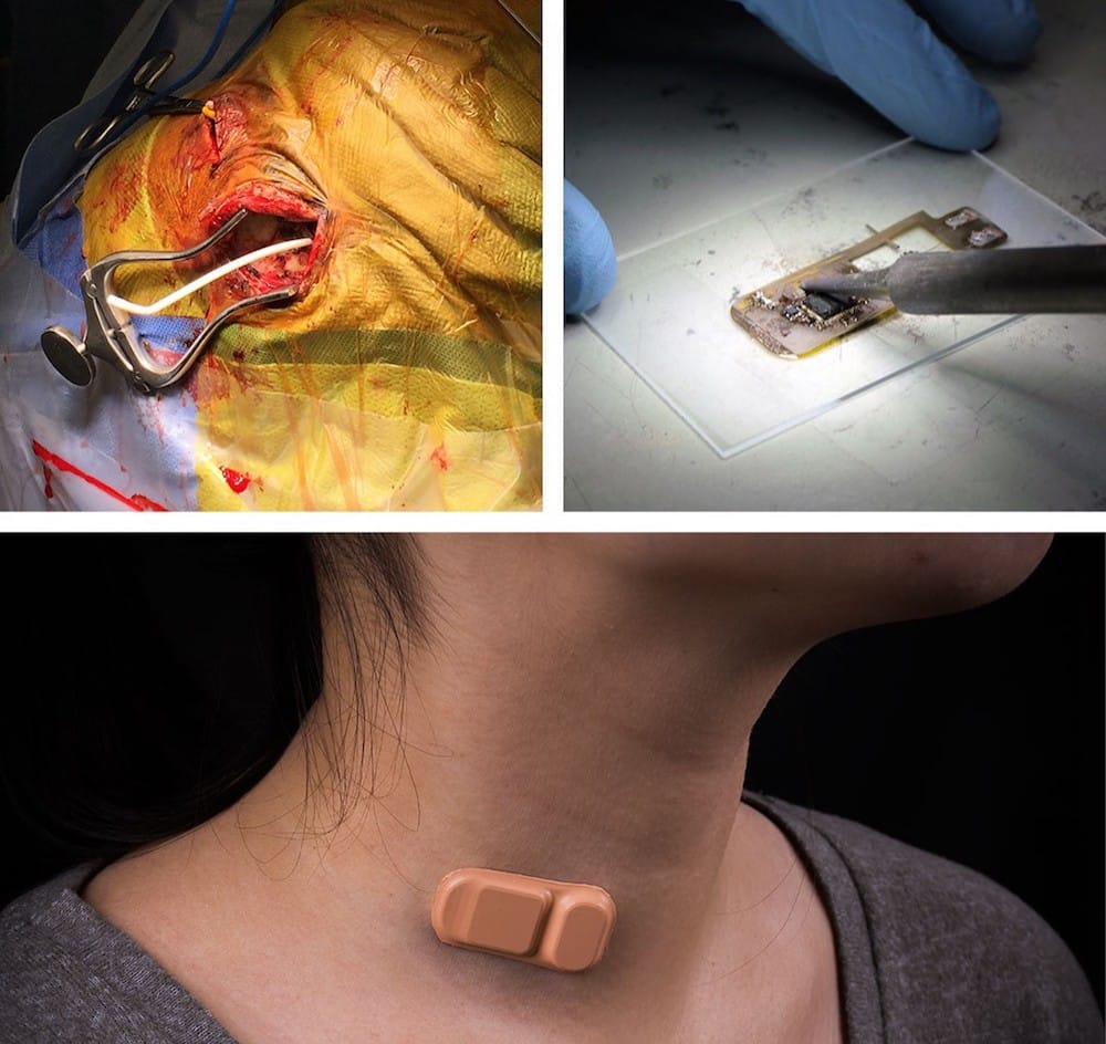 Top left: A shunt protruding from the brain during surgery. Top right: A researcher solders a new wearable shunt monitor. Bottom: A woman wears a new wearable shunt monitor on her neck. (Credit: Northwestern Uniersity)