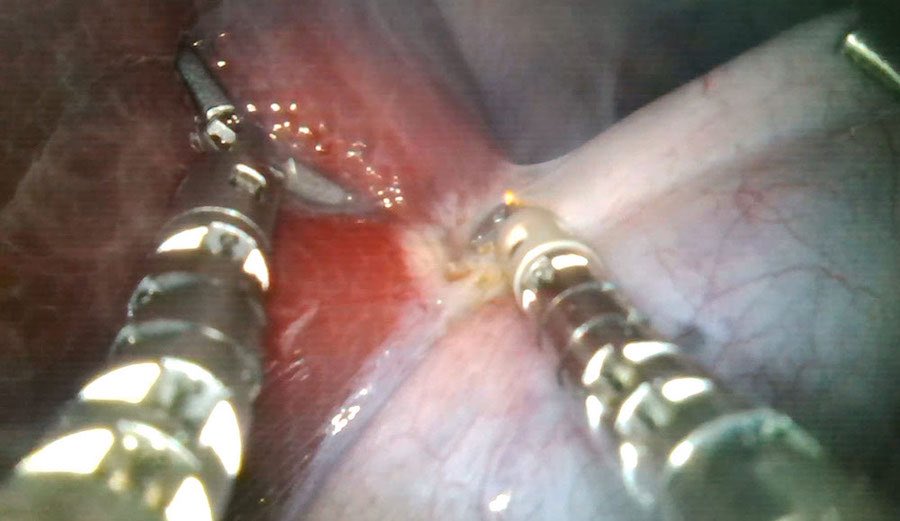 Photo of Robot incision on a porcine gallbladder