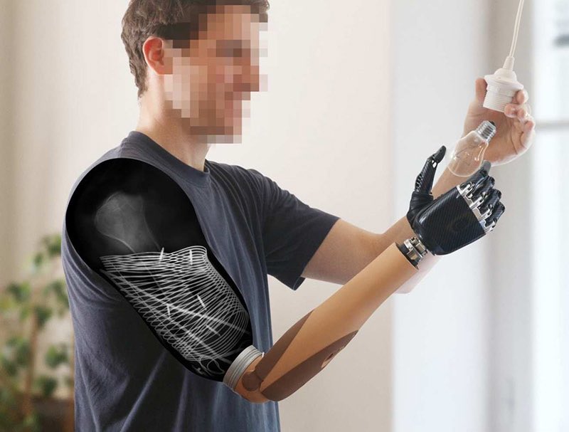 Image of prosthetics